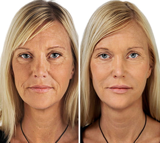 Collagen Select before after 3