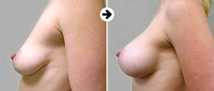 Breastfast before after 1