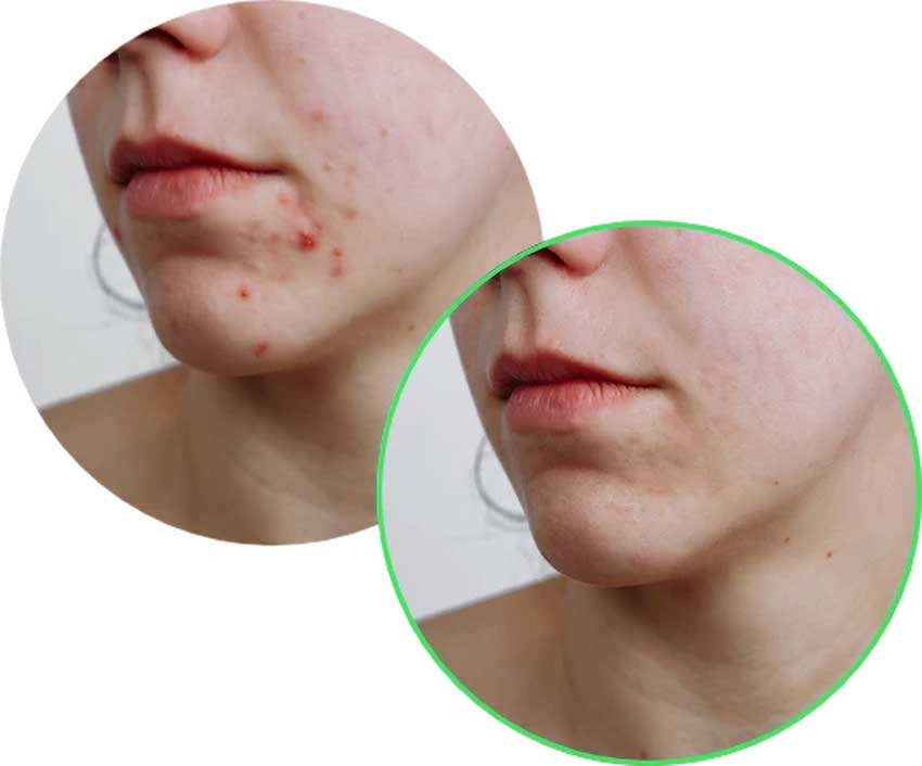 Revamin Acne Cream effects 1