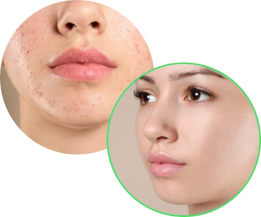 Revamin Acne Cream effects 1